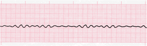 ventricular fibrillation tracing part 1