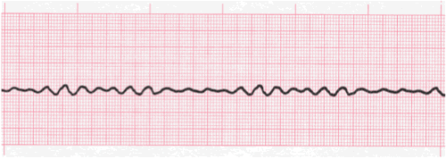 ventricular ecg image 120