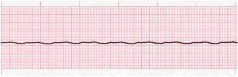 asystole tracing