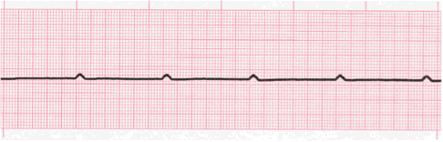 ventricular asystole tracing