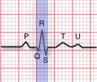 ekg QRS Interval