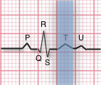 ekg T Wave