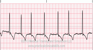 Atrial Fibrillation EKG strip