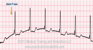 Accelerated Junctional Rhythm EKG strip