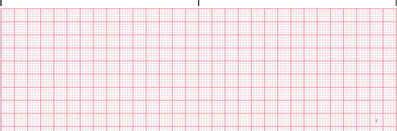 Premature Ventricular Complex - Quadrigeminy EKG tracing