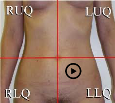 patient torso with stethoscope at tricuspid position