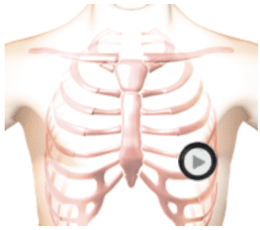 patient torso with stethoscope at mitral position