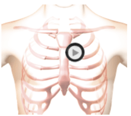 patient torso with stethoscope at tricuspid position