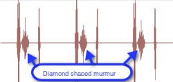 diamond shaped murmur