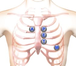 heart murmurs location areas