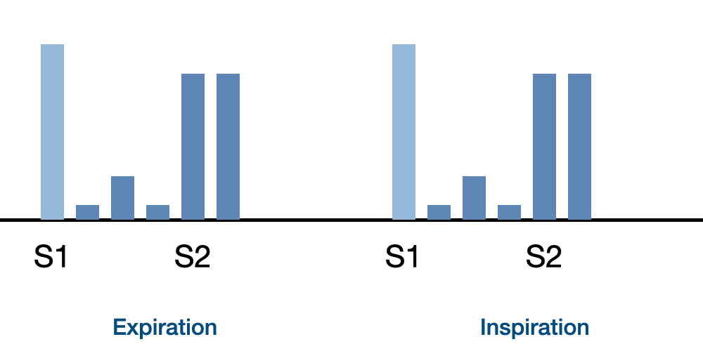 fixed s2 split heart sounds diagram