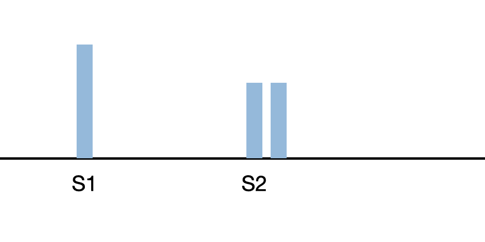 s2 split heart sounds diagram