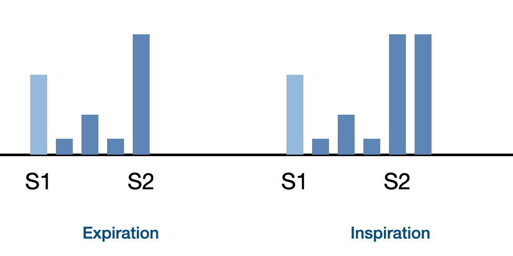 innocent murmur with S2 split diagram