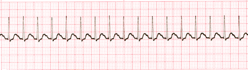 ecg rhythm strip for quiz