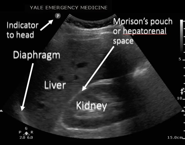 Finding Fluid: Morison's Pouch Finding Fluid