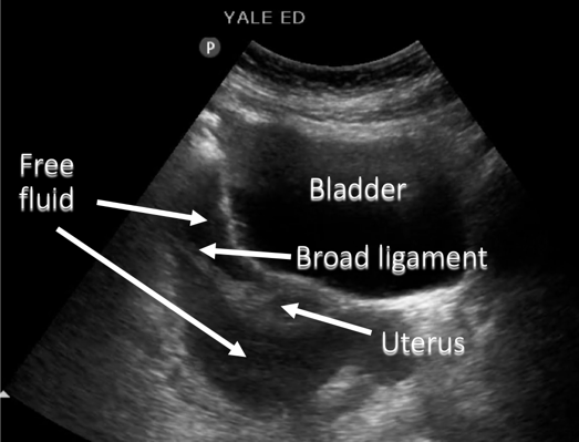 finding-fluid-pelvic-free-fluid-finding-fluid