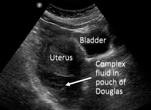 Finding Fluid Pelvic Free Fluid Finding Fluid