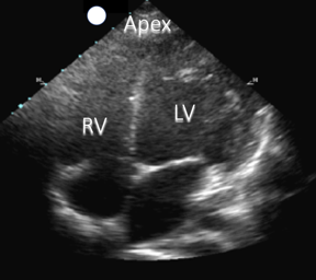 cardiac ultrasound image