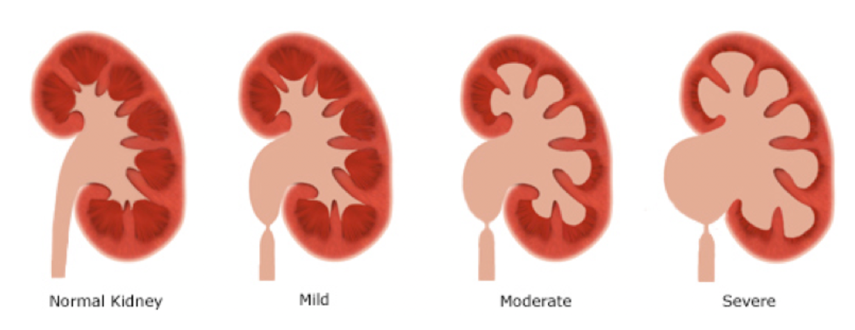 kidney hydronephrosis illustrations