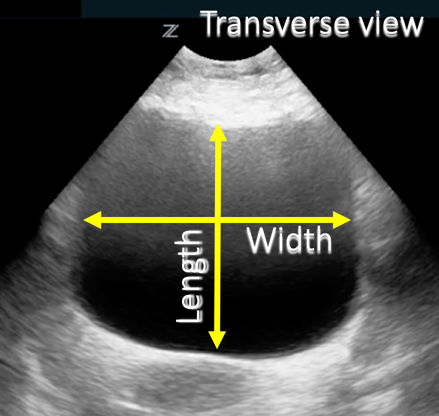 annotated point of care ultrasound image 2