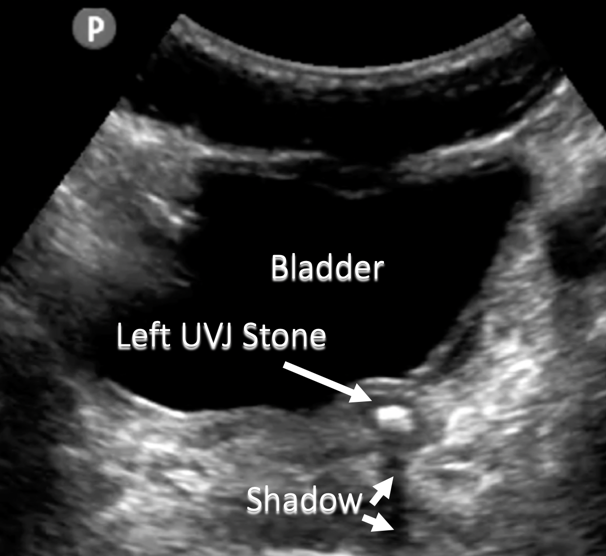 annotated point of care ultrasound image