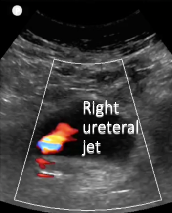 right ureteral jet