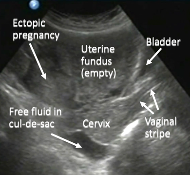 annotated ultrasound pregnancy image
