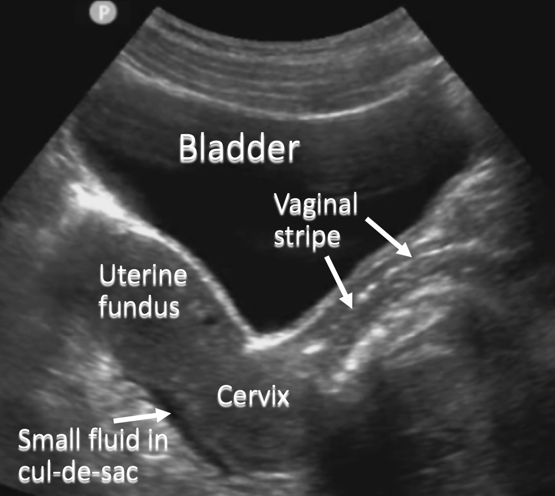 annotated ultrasound sagittal anatomy