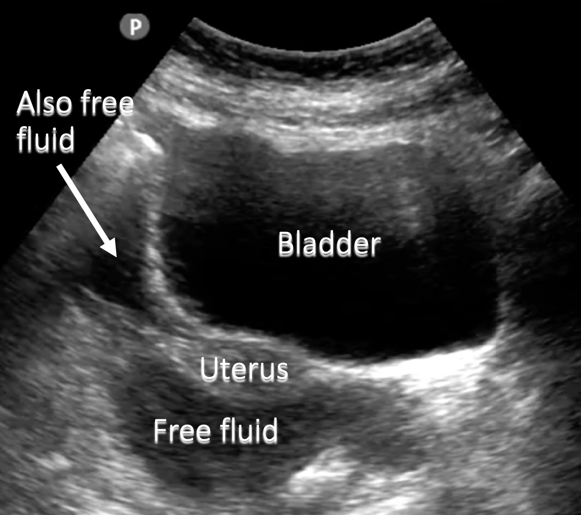 annotated ultrasound pelvic free fluid transverse