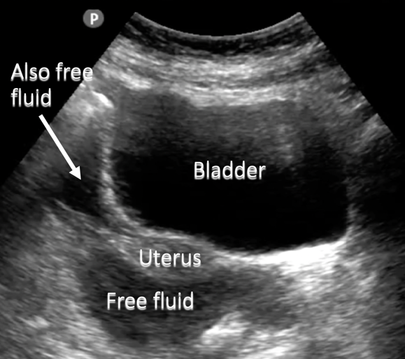 annotated ultrasound pelvic free fluid