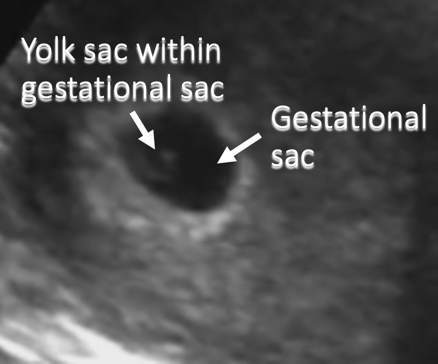 annotated ultrasound pregnancy