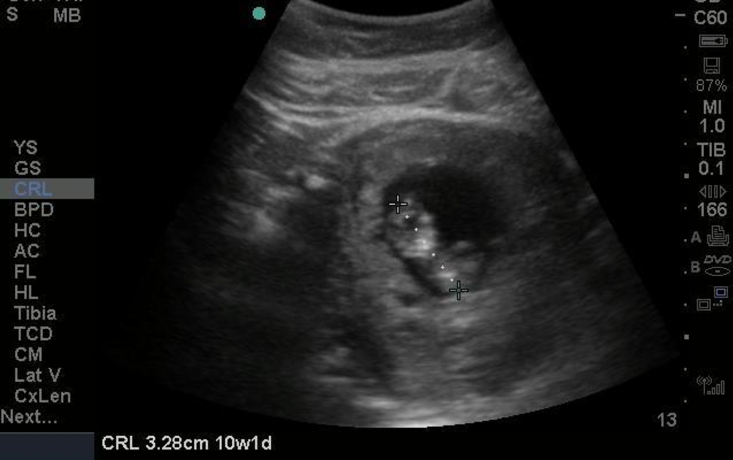 ultrasound display