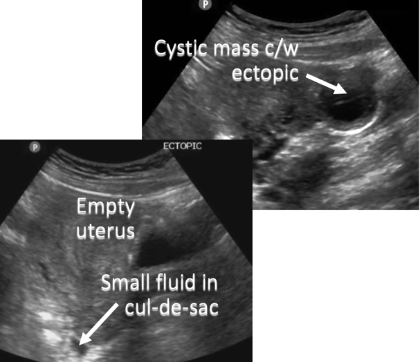 annotated ultrasound pregnancy
