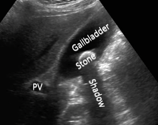 annotated ultrasound image gallbladder with stones