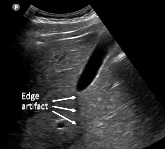 annotated ultrasound image edge artifact