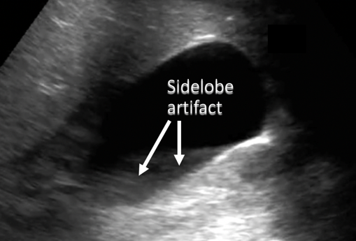 annotated ultrasound duodenum