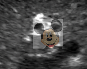 annotated ultrasound image 2