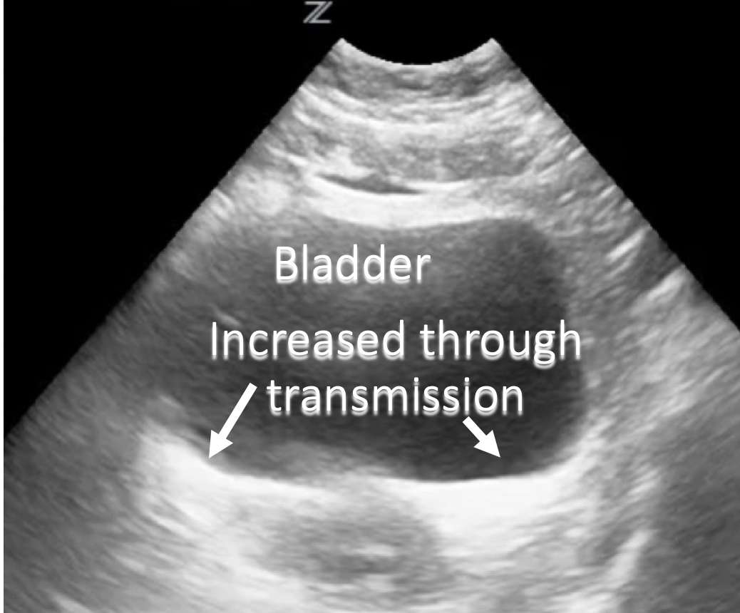 annotated ultrasound gallstones image