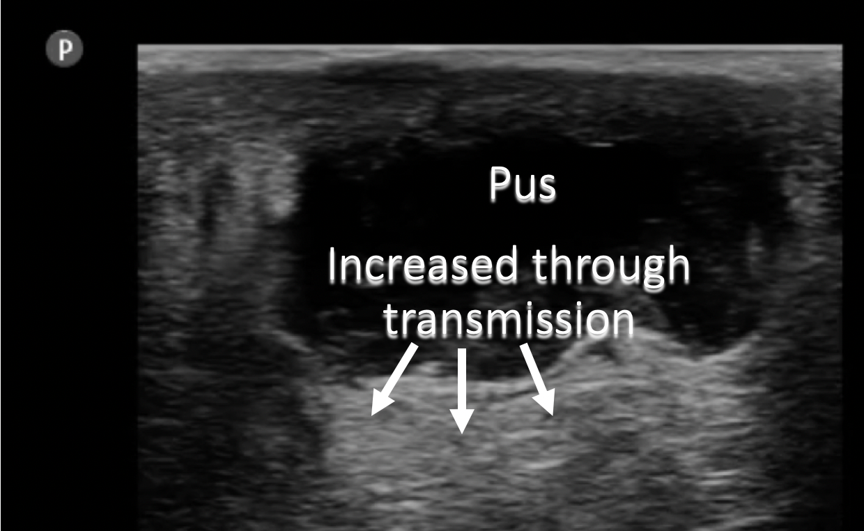 annotated ultrasound pus image