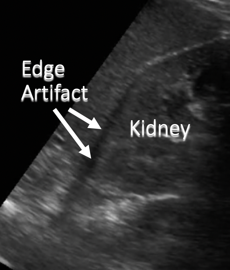 annotated ultrasound edge artifact