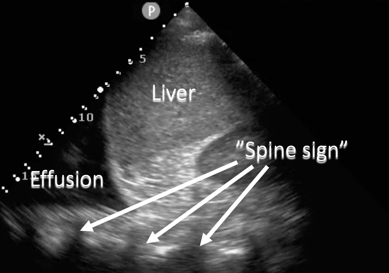 annotated ultrasound mirror image artifact