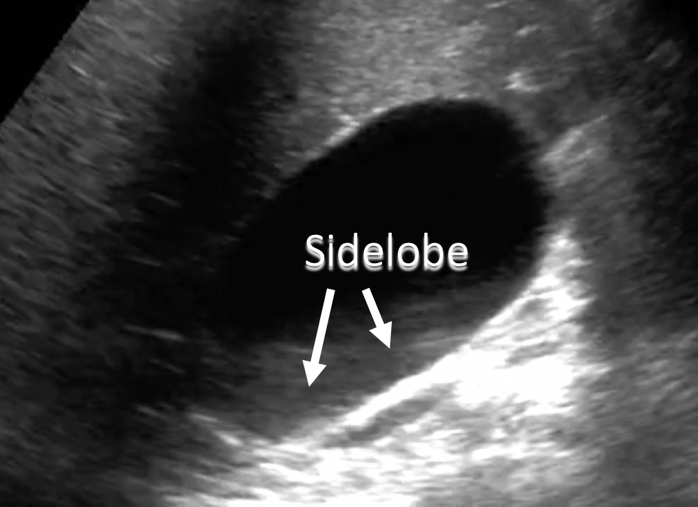 annotated ultrasound side lobe image