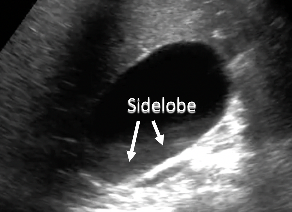 artifacts-in-ultrasound-sidelobe