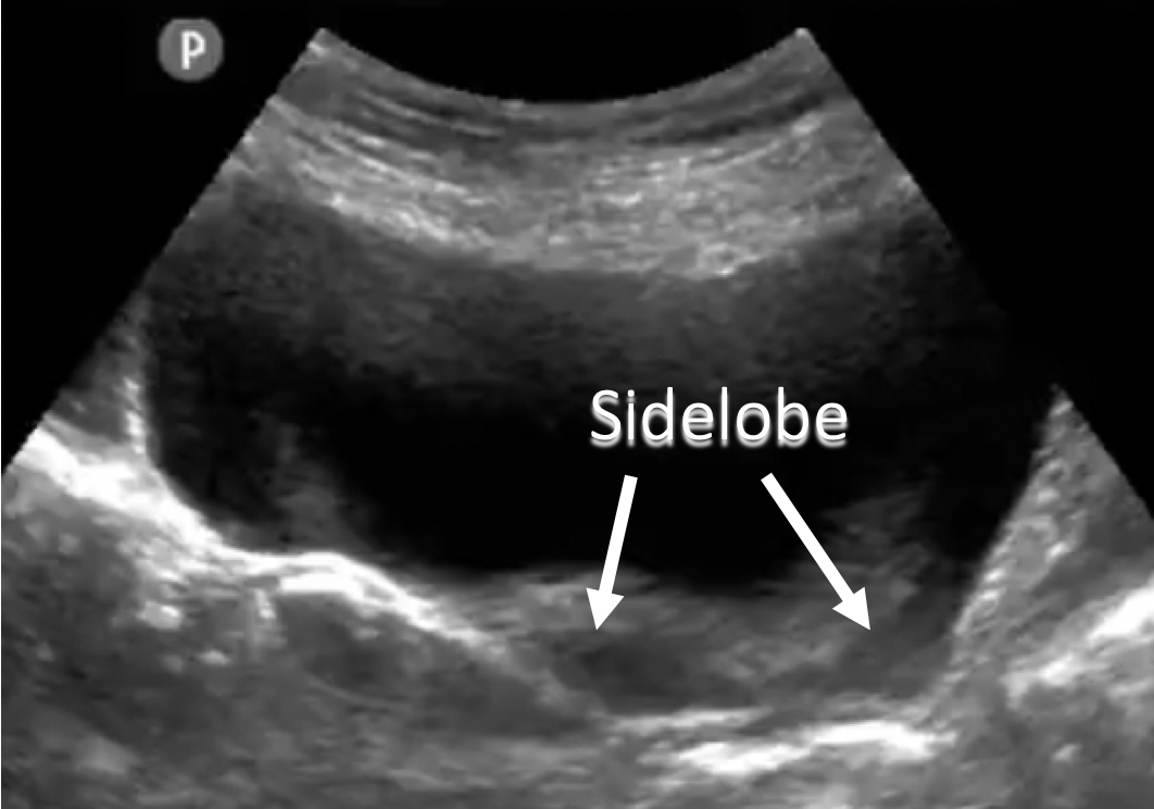 annotated ultrasound side lobe image