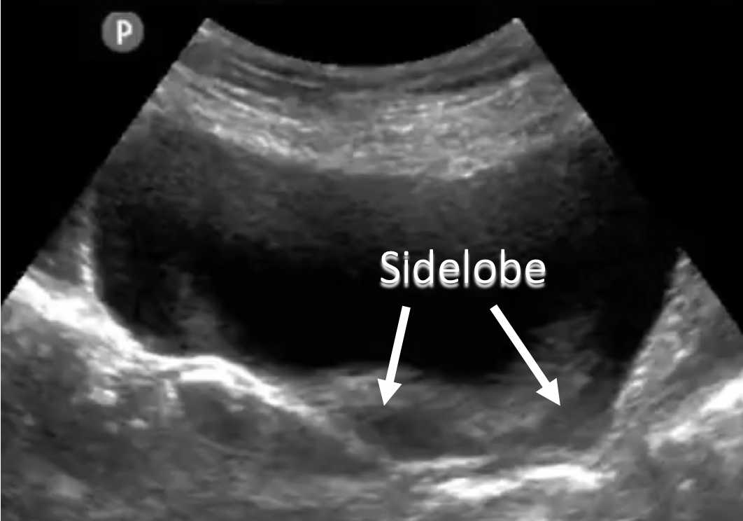 artifacts-in-ultrasound-sidelobe