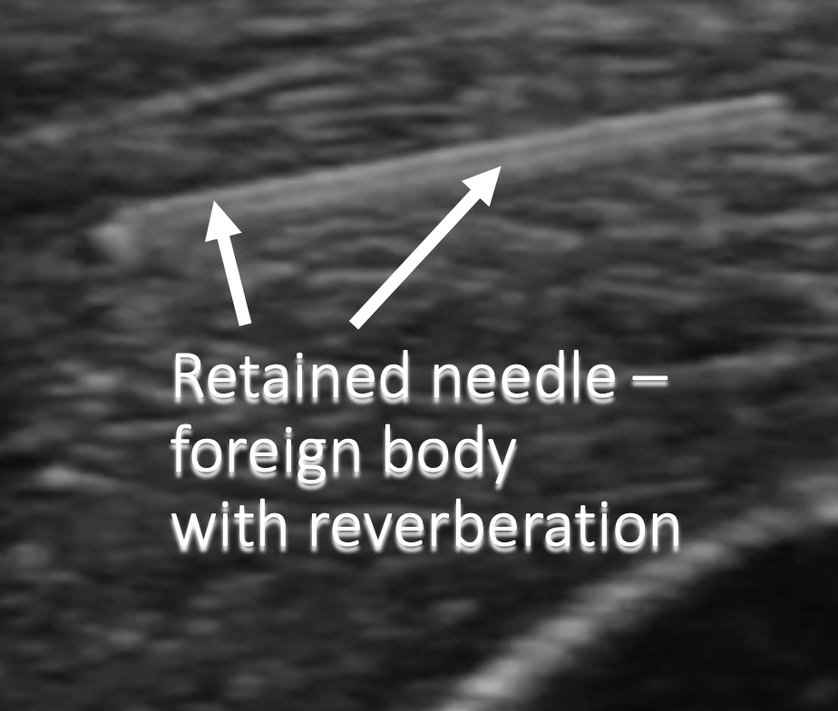 annotated ultrasound retained needle foreign body reverberation artifact