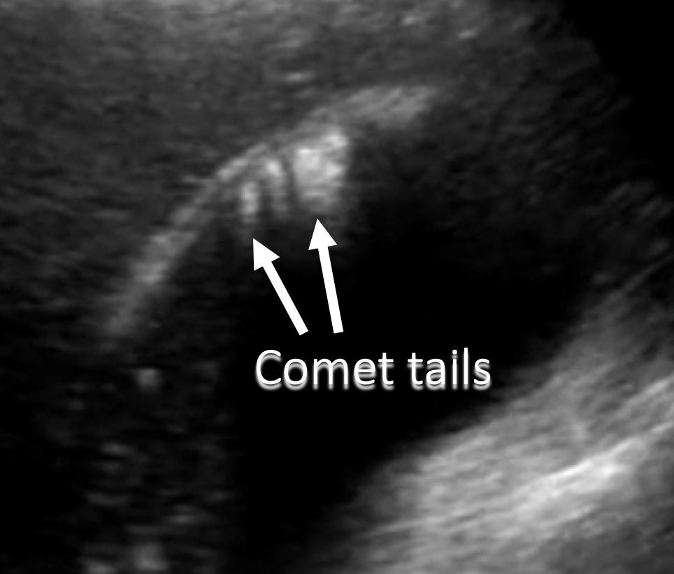 annotated ultrasound comet tails artifact