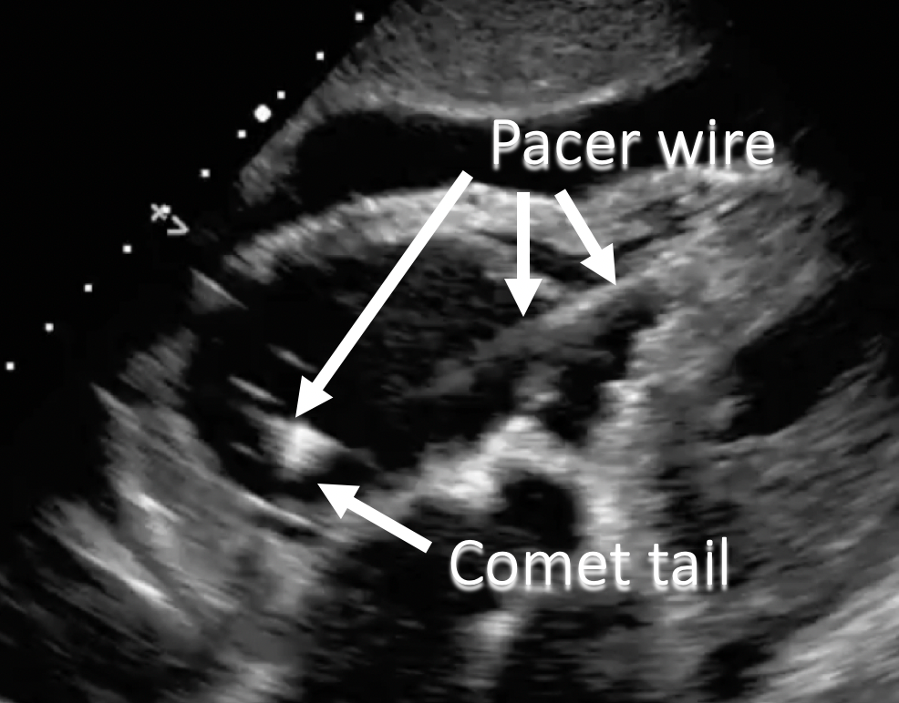 annotated ultrasound pacer wire comet tail artifact