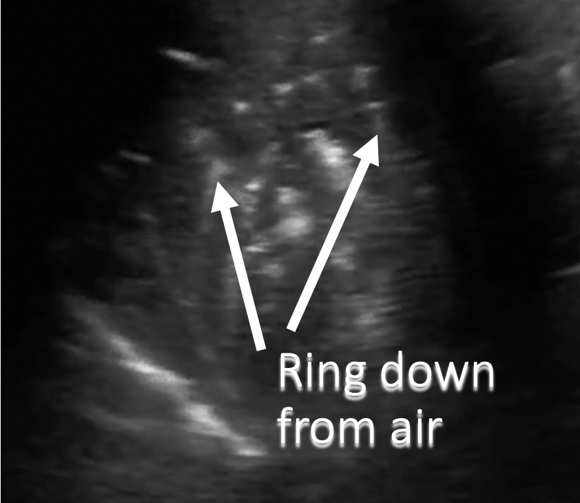 annotated ultrasound ring down from air artifact