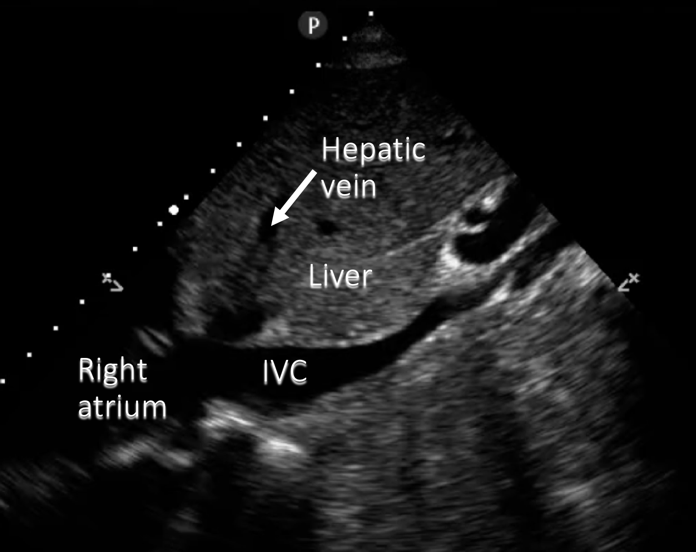 IVC ultrasound image annotated